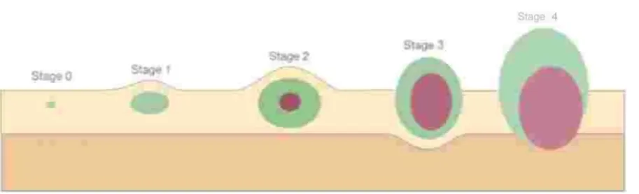 Gambar 1. ilustrasi staging pada tumor 