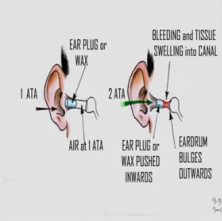 Gambar 9. Barotrauma penurunan (squeeze)  pada telinga luar (dikutip dari kepustakaan  9)