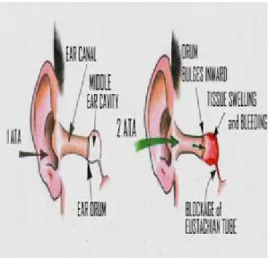Gambar 10. Barotrauma Penurunan (Squeeze) pada telinga tengah (dikutip dari kepustakaan 9)