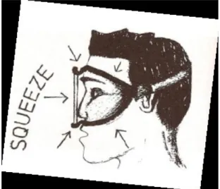 Gambar 12. Barotrauma pada Wajah (diambil dari kepustakaan 12)