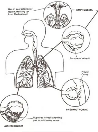 Gambar 13. Barotrauma pulmonal ascendens (dikutip dari kepustakaan 11)