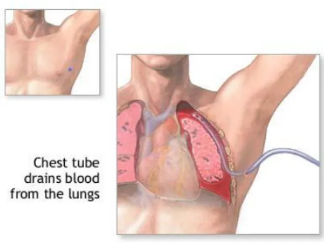 Gambar pemasangan chest tube 
