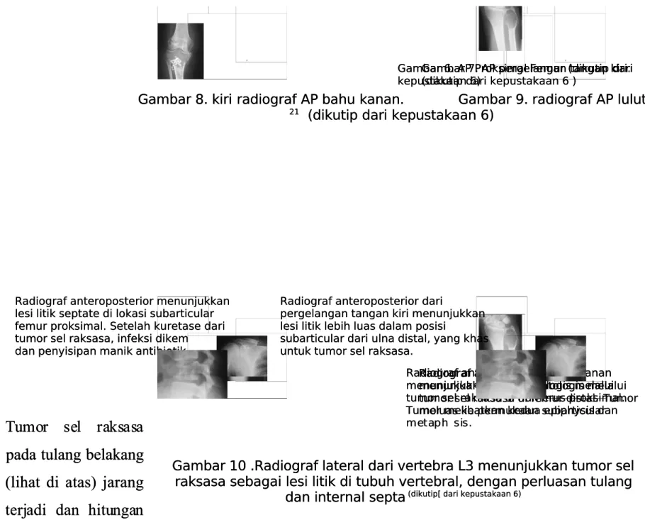 Gambar 10 .Radiograf lateral dari vertebra L3 menunjukkan tumor selGambar 10 .Radiograf lateral dari vertebra L3 menunjukkan tumor sel raksasa sebagai lesi litik di tubuh vertebral, dengan perluasan tulangraksasa sebagai lesi litik di tubuh vertebral, deng