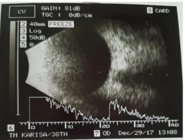 Gambar 2.2. Pemeriksaan ultrasonografi tanggal 29 Desember 2017 