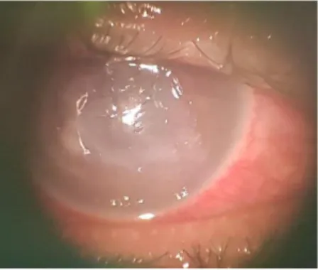 Gambar 2.4. Pemeriksaan slit lamp post keratektomi + anterior chamber wash out +  injeksi flukonazol intrastromal dan intrakameral hari ke 1