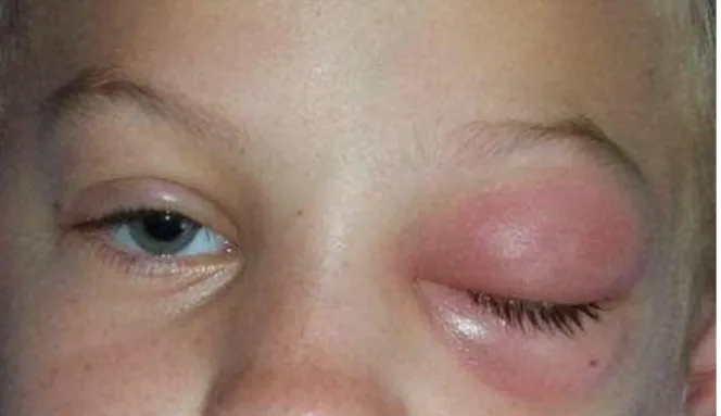 Gambar 4 selulitis preseptal mata kiri 