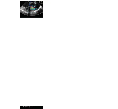 Gambar 2.8 VSD dengan pirau pada Tipe Membranous 11