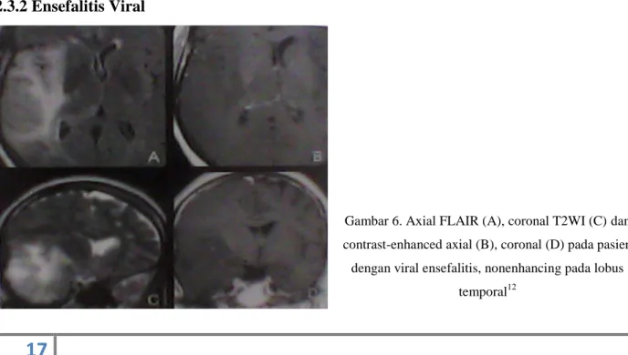 Gambar 6. Axial FLAIR (A), coronal T2WI (C) dan  contrast-enhanced axial (B), coronal (D) pada pasien  dengan viral ensefalitis, nonenhancing pada lobus 
