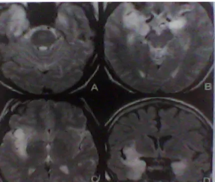 Gambar 7. Axial T2WI (A-C) dan coronal FLAIR (D) pada pasien herpes ensefalitis menunjukkan typical  cortical/subcortical high signal di kedua lobus temporal, insula kanan