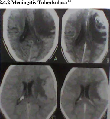 Gambar  9.  MR  scans  shows  TB  granuloma  with  profoundly  hypointense  center  with  T2WI  (A,B,panah  hitam), peripheral enhancement (C,D, panah putih) 12 Gambar  8
