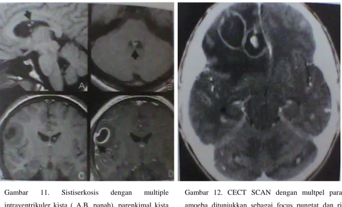 Gambar  11.  Sistiserkosis  dengan  multiple  intraventrikuler  kista  (  A,B,  panah),  parenkimal  kista    ( C,D)