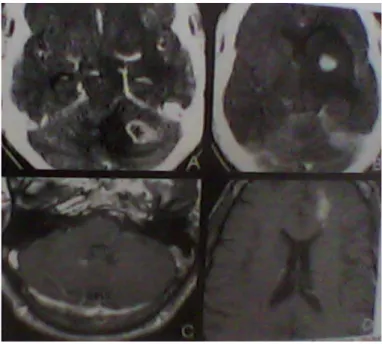 Gambar 13. (A,B) Axial CECT Scans in A HIV+ patient show ring enhancing masses in the cerebellum, basal  ganglia