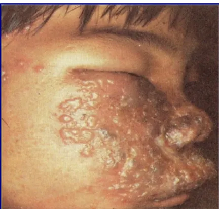 Gambar 4. Herpes zoster brakialis sinistra.