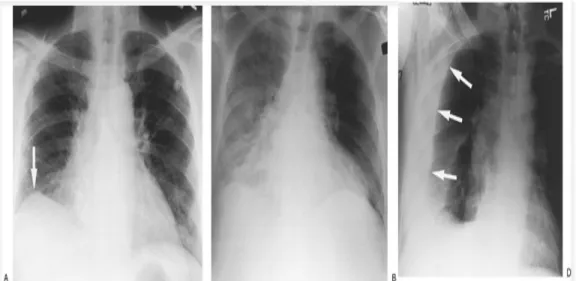 Gambar 4. A. Foto toraks PA menunjukkan elevasi dari hemidiafragma kanan      B. Meningkatnya opasitas pada bagian hemitoraks kanan akibat dari adanya cairan pleura 4
