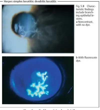 Gambar 9. Keratitis dendritik