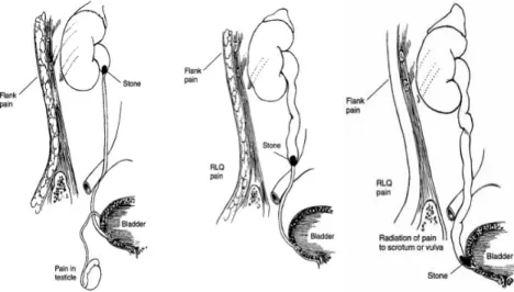 Gambar 2. Penjalaran nyeri sesuai posisi batu di ureter. 2