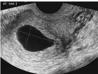 Gambar 2.1  Blighted ovum pada pemeriksaan transvaginal sonografi  Sumber : William’s Obstetri 23 (2010) 