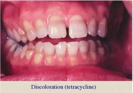 Gambar : discoloration ( tetracycline )