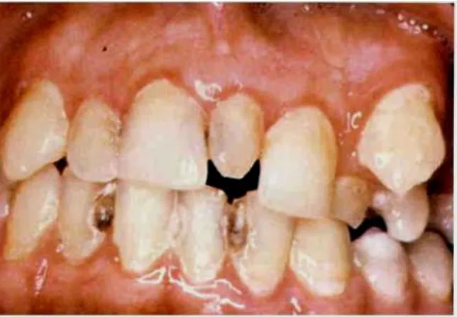 Gambar 1 : Supernumerary teeth, adalah gigi yang berlebih, sehingga jumlah gigi  yang terbentuk dalam rahang lebih banyak dari jumlah normal.