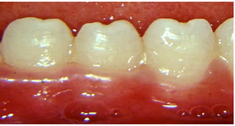 Gambar : Hutchinson teeth