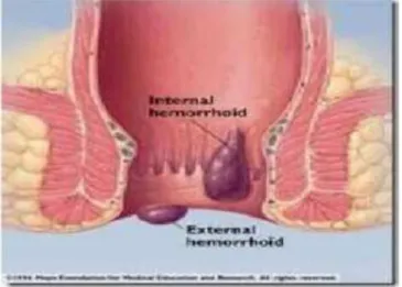 Gambar 3.5 Hemorrhoid interna dan eksterna(www.google.com)