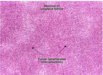 Gambar 2.2. Gambaran sitologi aspirasi Limfoma non Hodgkin diatas terdiri  dari folikel limfoid tumor limfosit (monomorfik) 
