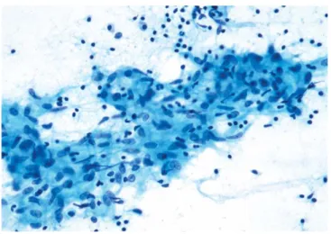 Gambar 2.5. Gambaran aspirasi biopsi pada limfadenitis TB, tampak histiosit  epiteloid dan sel-sel radang limfosit