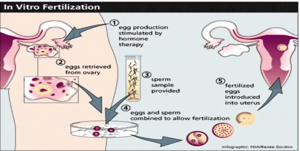 Gambar 2.3 In Vitro Fertilization