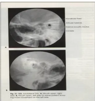 Gambar . Radiografi dengan teknik Transorbital Projection  c.  Transpharyngeal Projection 