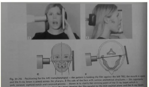 Gambar  .  Pengambilan  radiograf  dengan  teknik  Transpharyngeal  Projection. 