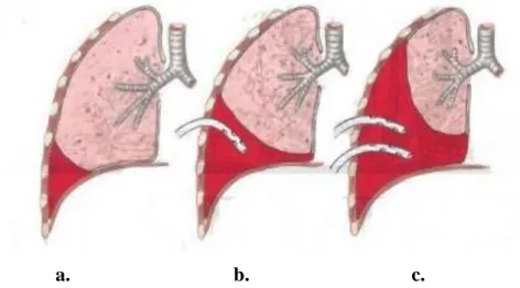 Gambar 4 . Klasifikasi hemotoraks a. Ringan b. Sedang c. Berat  2.6 GEJALA KLINIS  