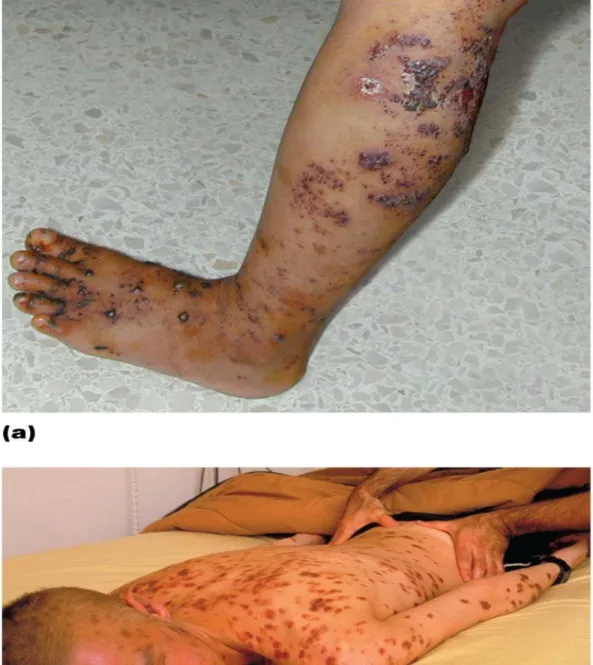 Figure 18.14 Diseases associated with AIDS-overview 