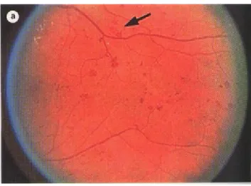 Gambar 7 :Intraretinal Microvascular Abnormalities (IRMA), berlokasi di retina  superficial berdekatan dengan area non perfusi.