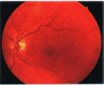 Gambar 10 : Mikroaneurisma dan hemorrhages pada backround diabetic  retinopathy