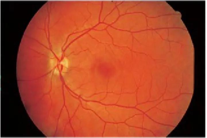 Gambar 3 : Foto Fundus: Retina Normal. Makula lutea terletak 3-4 mm kea rah temporal dan  sedikit dibawah disk optik, Diameter vena 1,5 kali lebih besar dari arteri.(Dikutip dari 