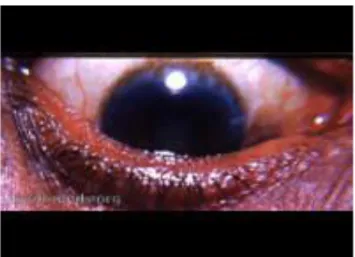 Gambar 10.  Herbert’s pits pada trachoma 