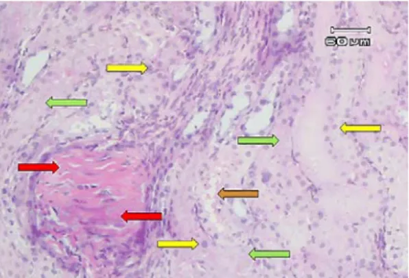 Gambar  5.  Gambaran mikroskopik ginjal tikus  wistar Kelompok IIIA (perlakuan injeksi  gentamisin 7 hari dilanjutkan ekstrak ubijalar  ungu 7 hari)