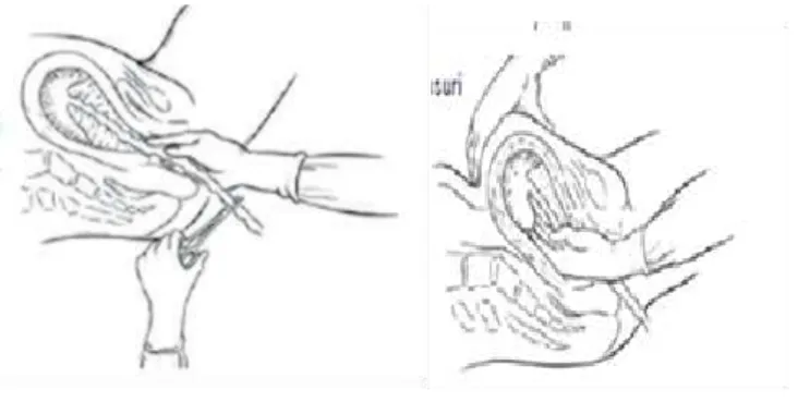 Gambar 2. Manual plasenta  