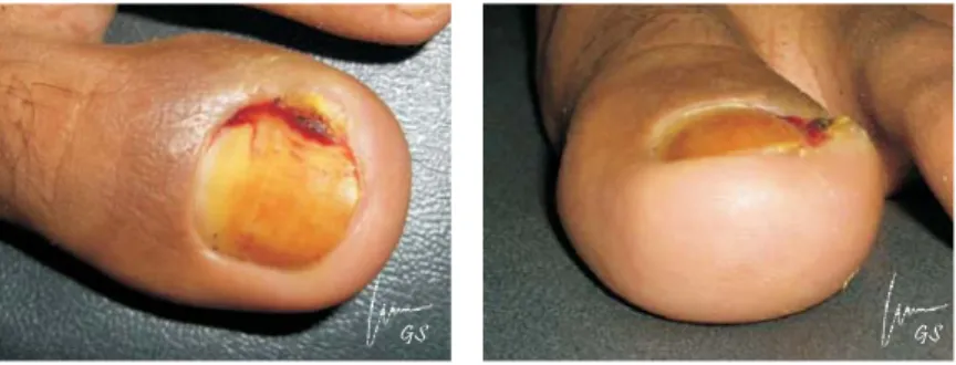 Gambar 51. Ingrowing toenail pada jari I kaki kiri bagian medial, sampai ke bagian proksimal