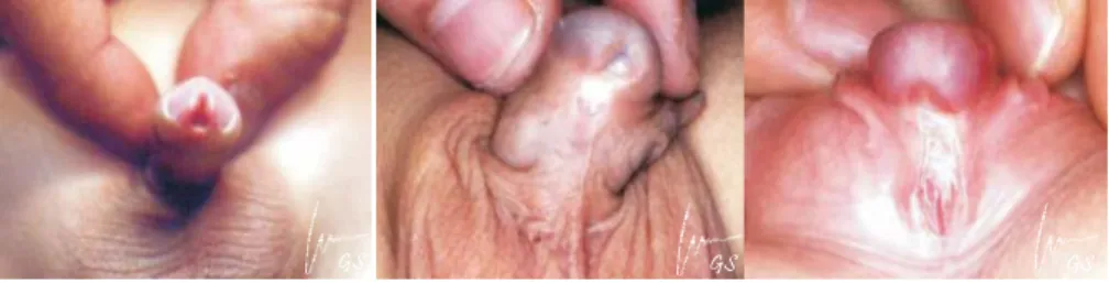 Gambar 47. Kiri: Hipospadia tipe glanular. Tengah: Tipe penile. Kanan: Tipe penoskrotal.