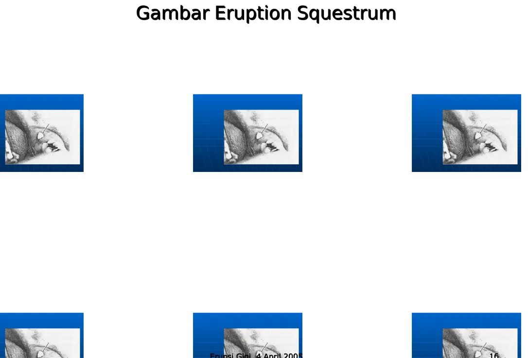 Gambar Eruption SquestrumGambar Eruption Squestrum