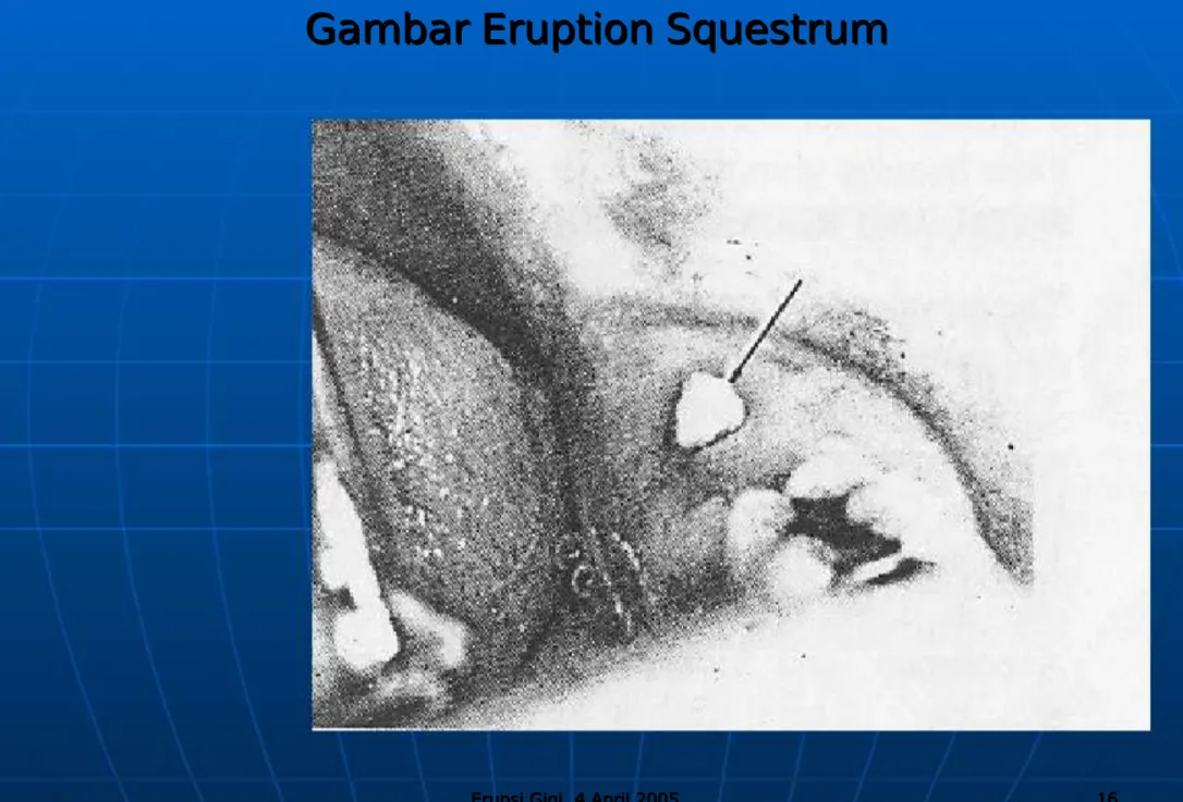 Gambar Eruption SquestrumGambar Eruption Squestrum