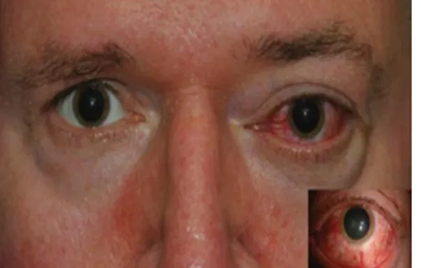 Gambar 3. Injeksi konjungtiva dan episklera mata  kiri pada pasien dengan carotid cavernous fistula 
