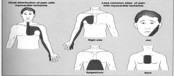 Gambar 3 : Pola nyeri dada pada iskemia miokard Pemeriksaan Fisik