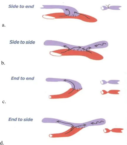 Gambar 2.5. Jenis teknik penyambungan a).side (arteri radialis) to end (vena  cephalica); b.side (arteri radialis) to side (vena cephalica); c.end (arteri radialis) to 