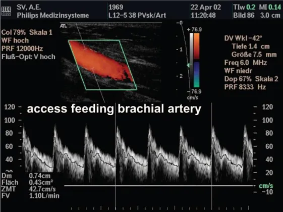 Gambar 2.6. Hasil pemeriksaan Colour Doppler ultrasound untuk mengetahui  volume aliran darah pada arteri brachialis (Wiese dan Daniel, 2004)