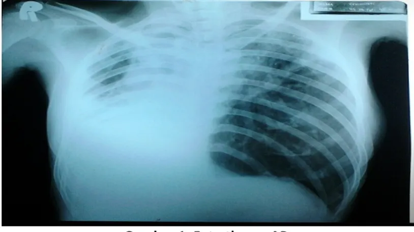 Gambar	1.	Foto	thorax	AP.	 	