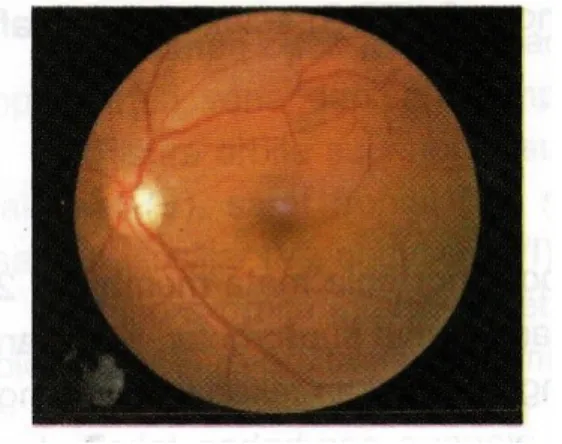 Gambar 5. Fundus okuli normal