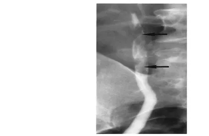 Gambar 2.11 Gambaran filling defect (panah) di ureter adalah karakteristik dari polip fibroepithelial.