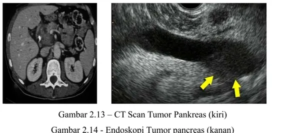 Gambar 2.12 - Transisi Cell Carcinoma. Radiografi dari urogram ekskretoris menunjukkan massa lobulated (panah) yang menyebabkan kelainan di dasar
